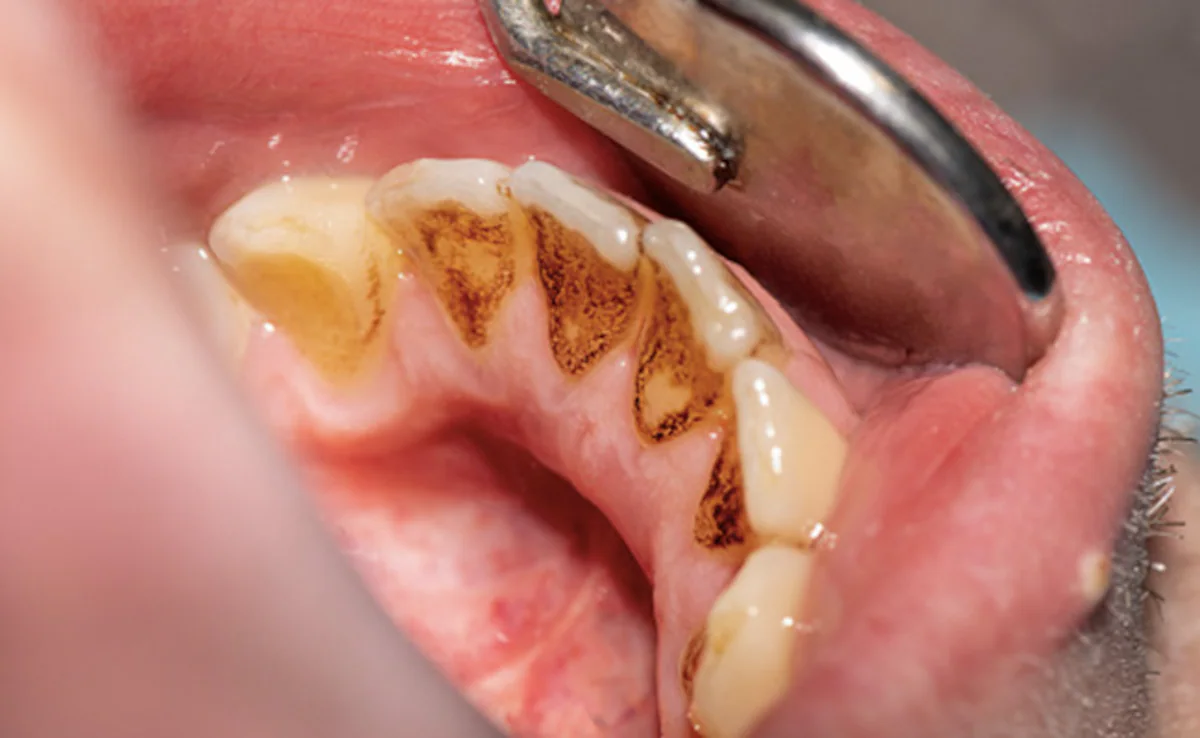 home-remedies-to-whiten-teeth