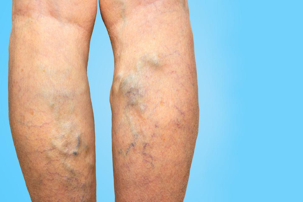 aricose Vein घरेलू इलाज