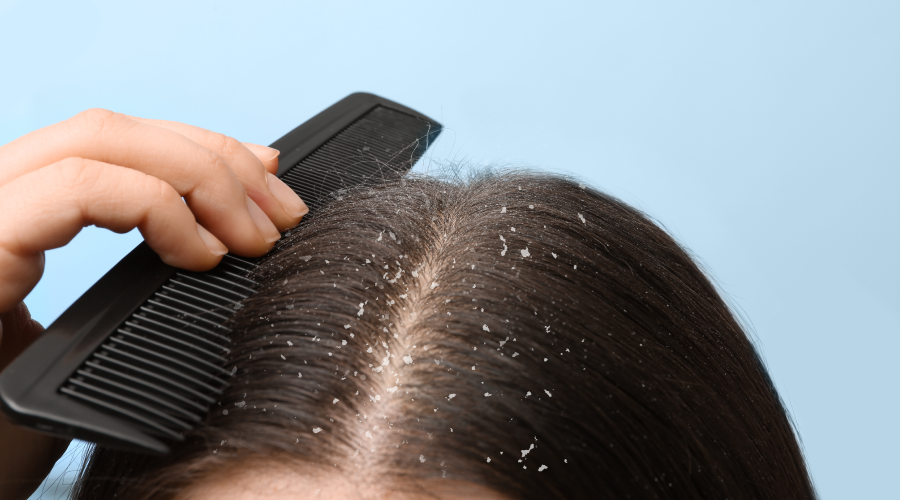 home-remedies-to-reduce-dandruff