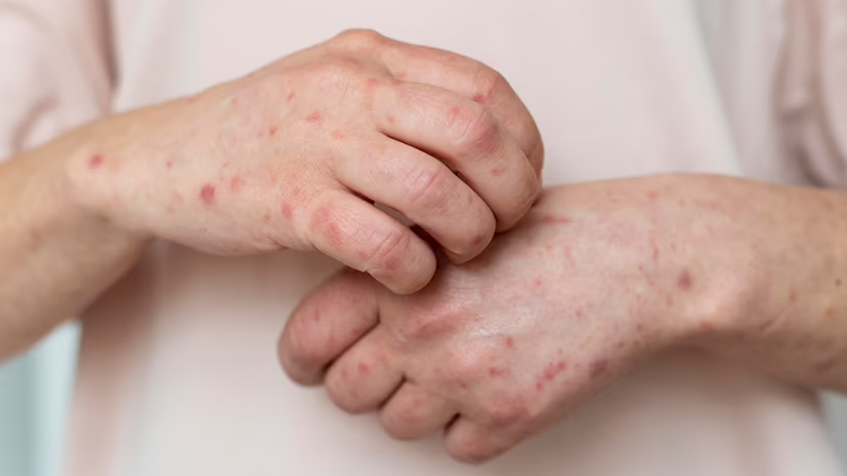home-remedies-for-ringworm