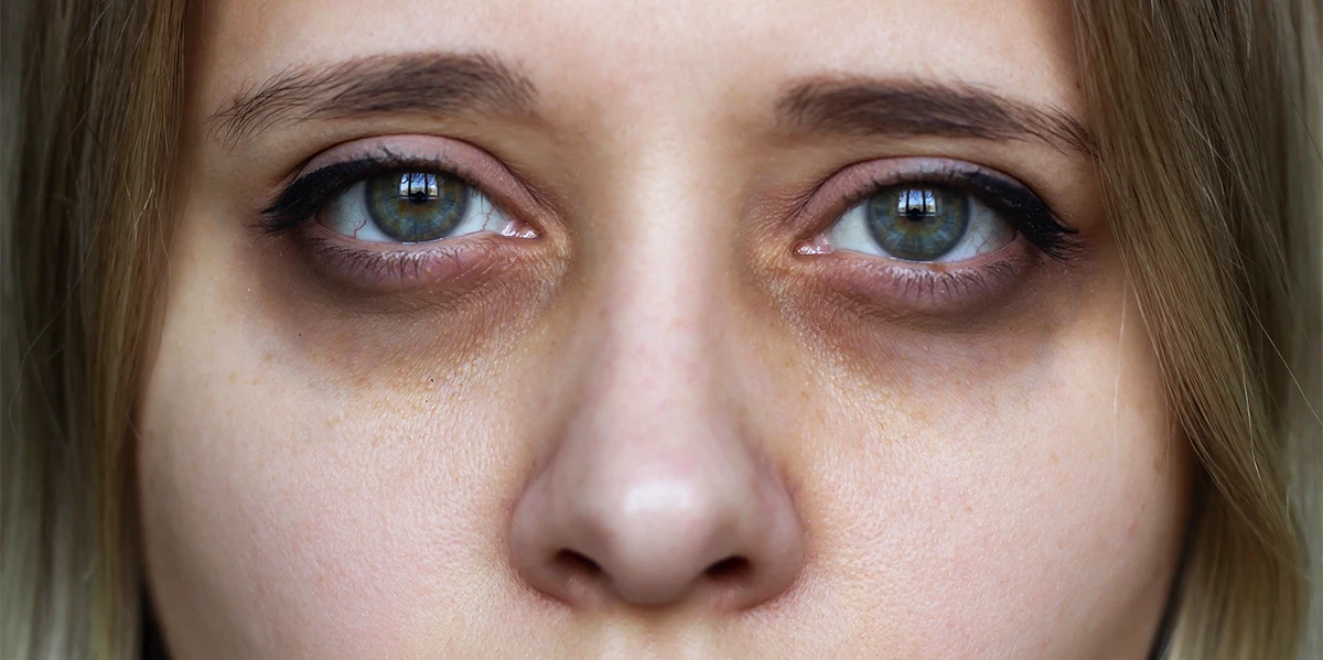 remedies-to-remove-dark-circles